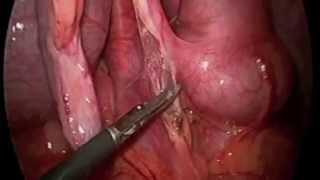 Laparoscopic Appendectomy