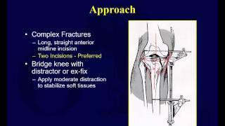 Tibial plateau fractures 1