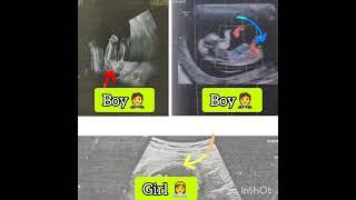 Ultrasound scan report baby boy or girl? Gender reveal #shorts #genderreveal #ultrasound #boyorgirl