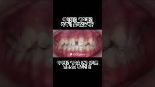 예측과 부합하는 덧니 교정치료 결과