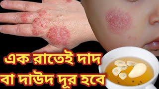 দাউদ বা ফাঙ্গাল ইনফেকশন এর ঘরোয়া চিকিৎসা | দাদ খাজ খুজলি একজিমা চুলকানি থেকে ১ দিনে মুক্তি ১০০%