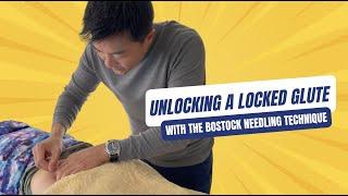 How I Unlock A Locked Glute. See the Bostock Needle Technique in Action!