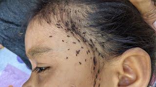 Remove all hundred head lice - Pick out all those head lice from hair