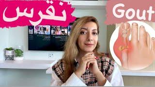 نقرس(علائم، علت، تشخیص،درمان)/GOUT