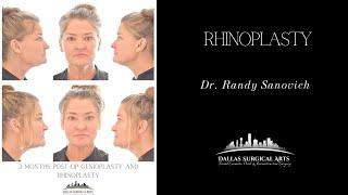 A Look Inside The OR: Rhinoplasty by Dr. Randy Sanovich