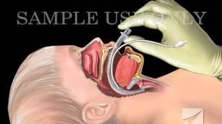 Tracheal Intubation: Laryngeal Mask Airway Device