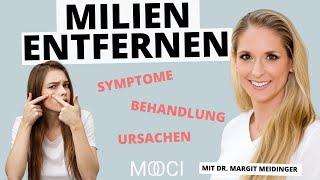 Milien - Wie kann man sie entfernen?