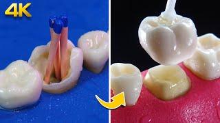 AMAZING restoration of tooth damaged by cavities: Dental Crown