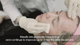 Fractora Face Treatment | Rejuuv Medi Spa | Toronto ON