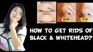 HOW TO GET RID OF BLACK & WHITEHEADS