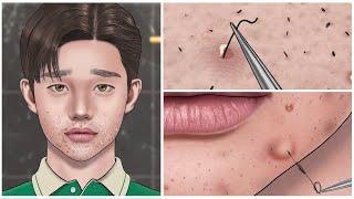 [ASMR] Satisfactory ingrown hair removal animation