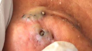 lots of big blackheads behind the ears... satisfying video