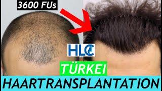 Haartransplantation Türkei | FUE Haartransplantation | Vorher Nachher | 3600 FUs von HLC Ankara