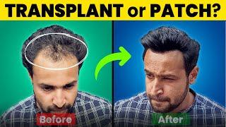 Best Quality Glue Hair Systems in India | American Hairline