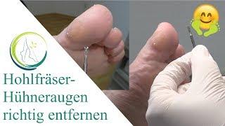 Hohlfräser- Hühneraugen richtig entfernen