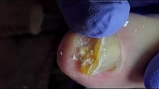 DIY Ingrown Toenail Removal | How to Safely Cut Ingrown Toenails at Home