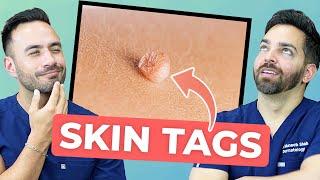 HOW TO TREAT SKIN TAGS LIKE A DERMATOLOGIST