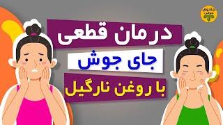 جای جوش: درمان جای جوش | جای جوش صورت #جادوی_جوانی #درمان #پزشکی