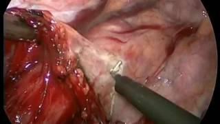 Video 1. VATS mobilisation of the thoracic esophagus.