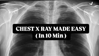 Chest X Rays (CXR) Made Easy! - Learn in 10 Minutes!