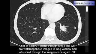 CT chest : Round atelectasis ( by hammadshams )