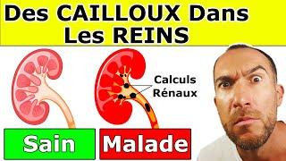 CALCULS RÉNAUX : Causes, Symptômes, Aliments Interdits et Remèdes Naturels