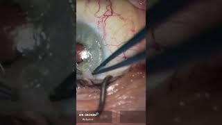 Fixing corneal scars from pterygium surgery with superficial keratectomy. #cornea #cornealscars