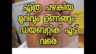 എല്ലാവരും അറിഞ്ഞിരിക്കേണ്ട മുറിവിനുള്ള ഒറ്റമൂലി| /Malayalam Health Tips| Dinu Varghese