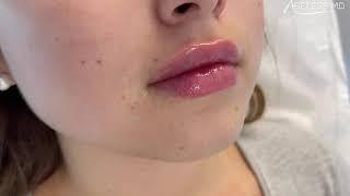 Juicy Lip Filler Treatment - Ageless MD , we love a good lippie!