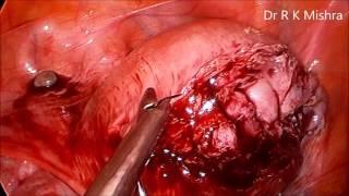 Laparoscopic Myomectomy for Intramural Myoma