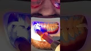 Teeth whitening process