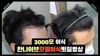 #모발이식후기 수술 후 6개월 빗질 영상 [절개3000모] I 한나이브성형외과