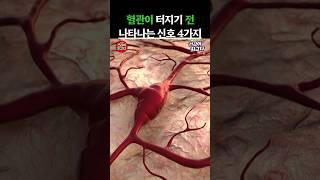 혈관이 터지기전 나타나는 신호 4가지 #건강정보 #음식
