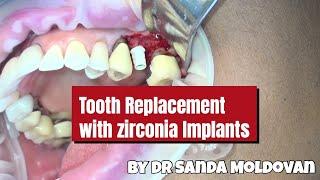 Why Ceramic Implants Are the Future of Dentistry