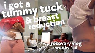 Tummy Tuck & Reduction Recovery Weeks 1-4