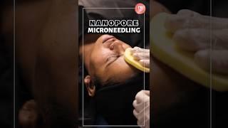 Want skin that glows from within? Try NanoPore Microneedling #Skincare #Shorts #sbaesthetics