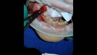 Surgical Extraction with Root Tip Removal and Gelfoam Placement Lower Molar