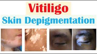 Vitiligo (Skin Depigmentation) | Pathophysiology, Signs and Symptoms, Diagnosis, Treatment