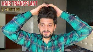 My Hair Transplant Results After 3 Years | My Hair Transplant Cost, Medicine, Care, Experience |