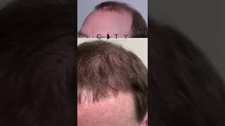 FUE Hair Transplant Results (2,500 Grafts)