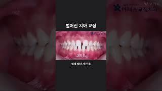 벌어진 치아 교정치료로 해결이 가능해요!! #치아교정 #교정전문의 #교정전문치과