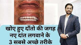 खोए हुए दाँत लगवाने के 3 प्रकार और खर्च ! Three Teeth replacement options and cost ! By Dr Ankit