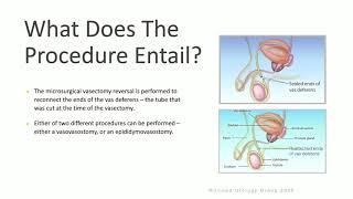 Vasectomy Reversal