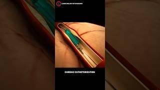 cardiac Catheterization animation _#shorts