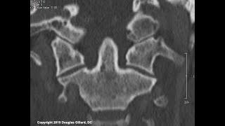 Upper Cervical Anatomy: (Part II): Embryology & Anomaly, Suboccipital Triangle, and Meet Axis