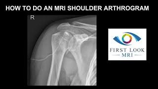 How to do an MRI shoulder arthrogram