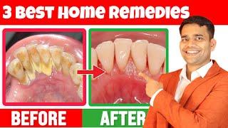 3 Remedies To Remove yellowness, Plaque, Cavities, and Gingivitis - Dr. Vivek Joshi