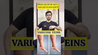 Best Exercises for Varicose Veins #shorts