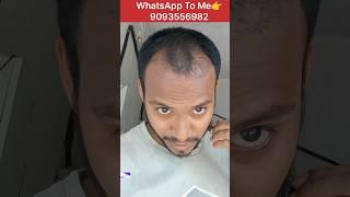 BOLD TO HAIR JOURNEY ️ #hairtransplant