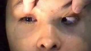 Microftalmo
